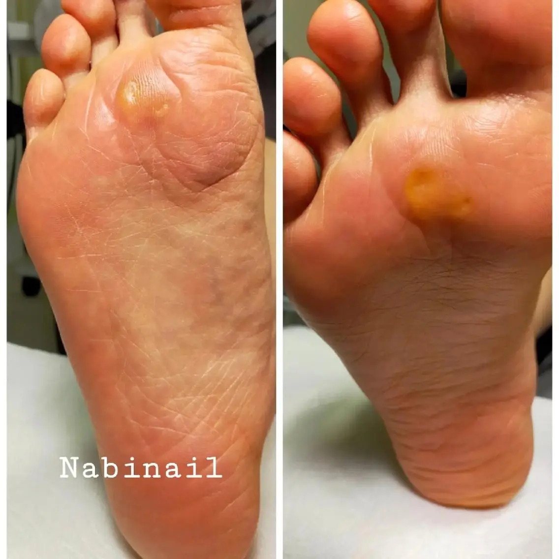 フットケア+角質ケアの写真
