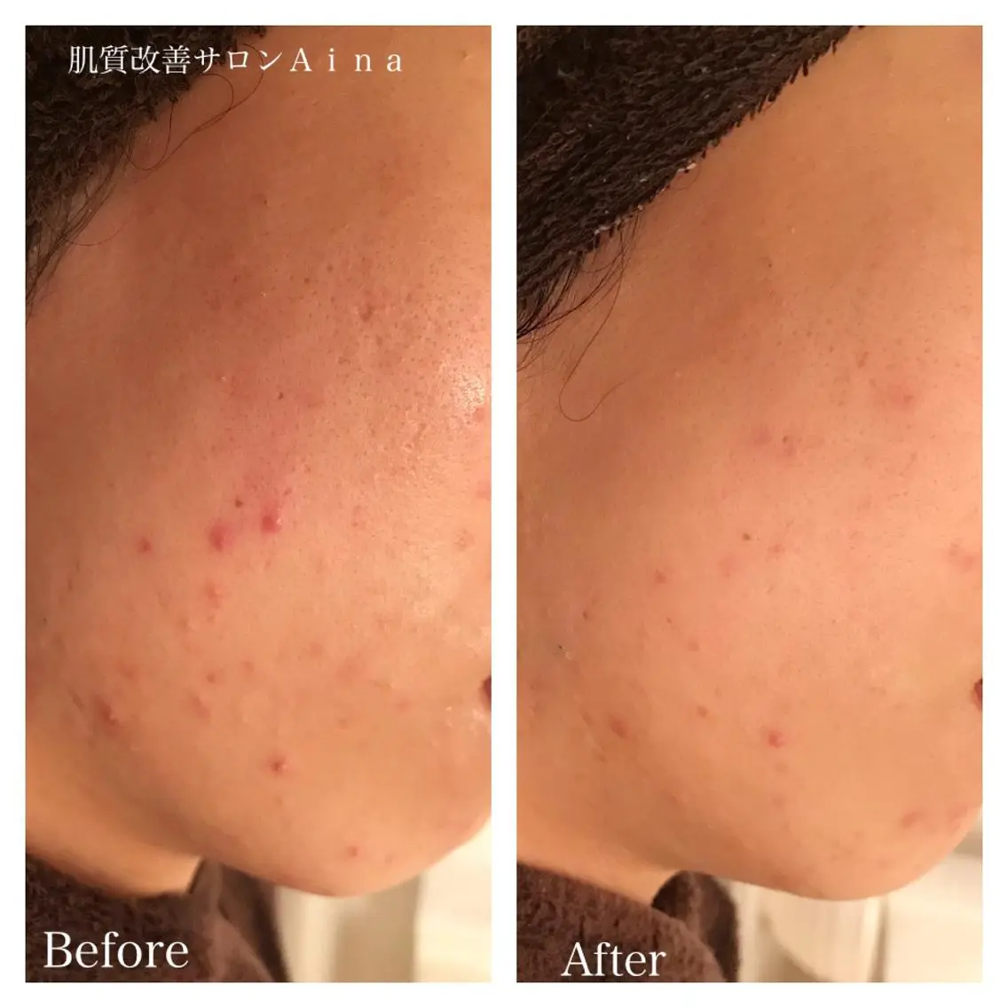 セミロング カラー パーマ ヘアアレンジ キッズ ネイル マツエク・マツパ 卒業式のヘアスタイル 卒業式 赤色 エステ リラク ニキビ跡専門サロン Ainaのエステ・リラクイメージ