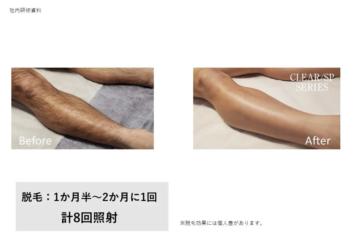 両脚全部パック(甲・指込み)の写真