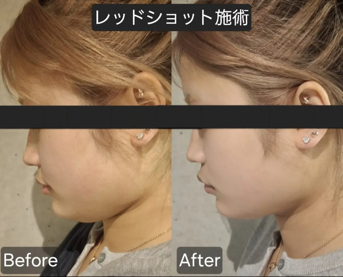 初回✨【レッドショット導入】輪郭形成✨フェイスライン 、たるみ、二重アゴに（お悩みに合わせての施術になります）の写真