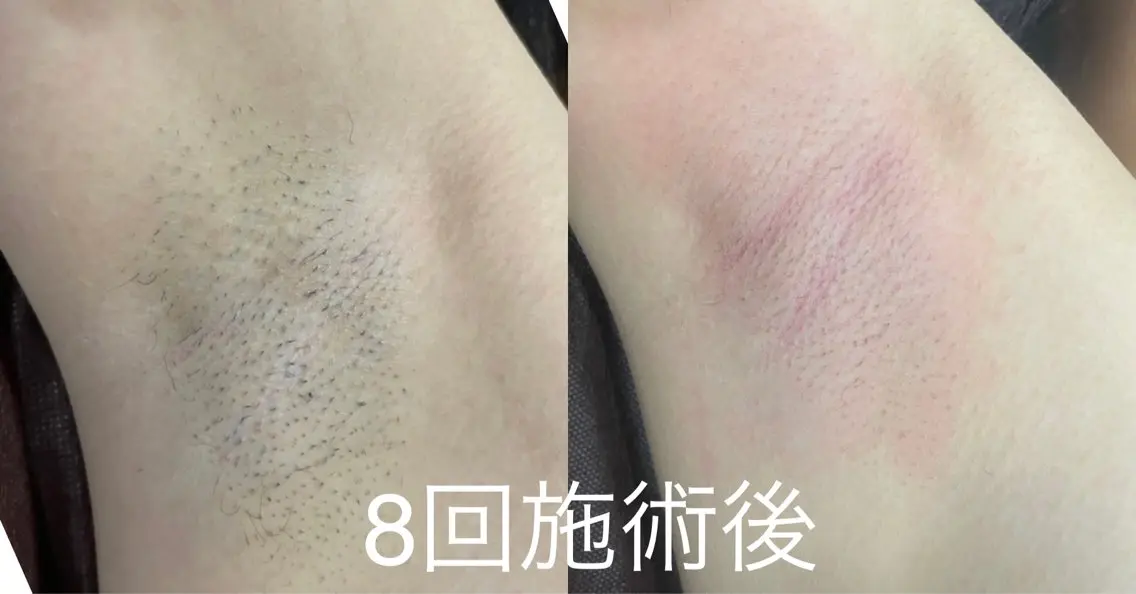 全身脱毛(ドイツ製のハイブリッドの機使用)圧倒的な効果是非お試しください！こちらは初回のみになります！🙇の写真