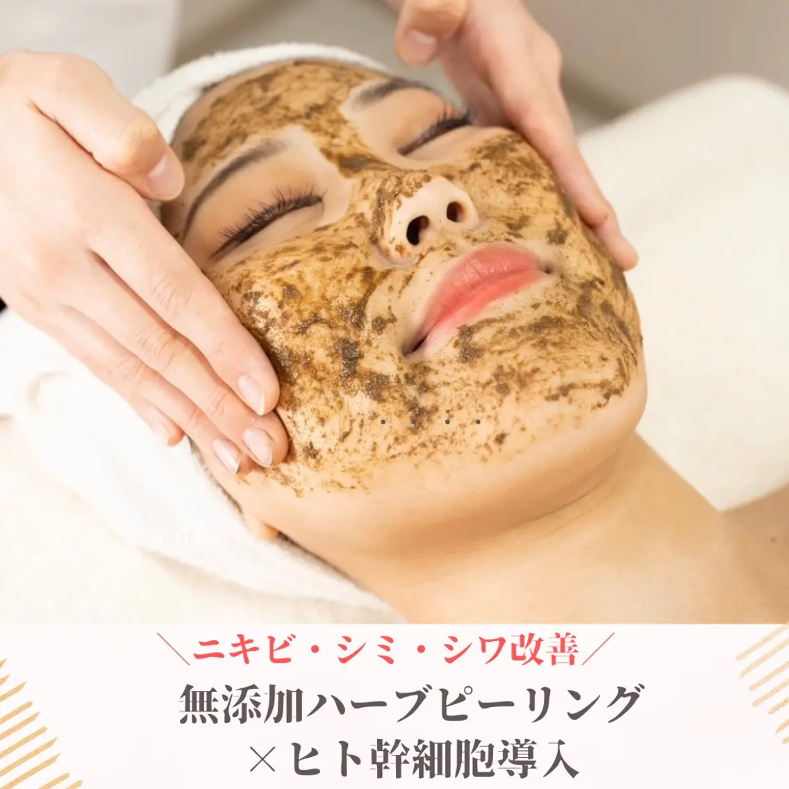 【人気NO1 本気の肌質改善】ハーブピーリング×ヒト幹細胞ポレーション導入の写真