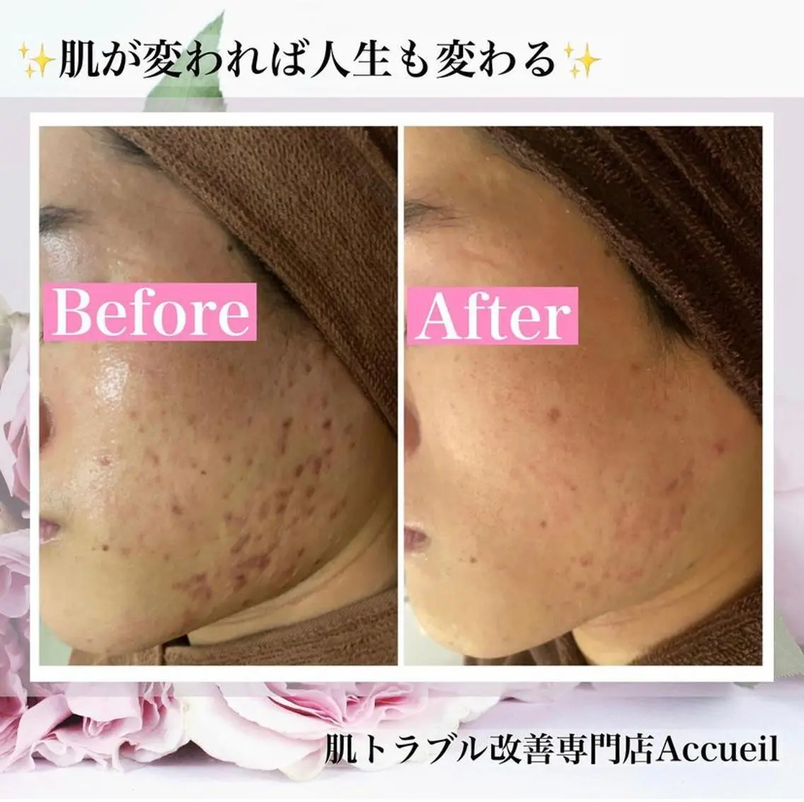 ミディアム カラー パーマ ヘアアレンジ キッズ ネイル マツエク・マツパ エステ リラク ニキビ・肌質改善専門 ♡人生が変わるサロンのエステ・リラクイメージ