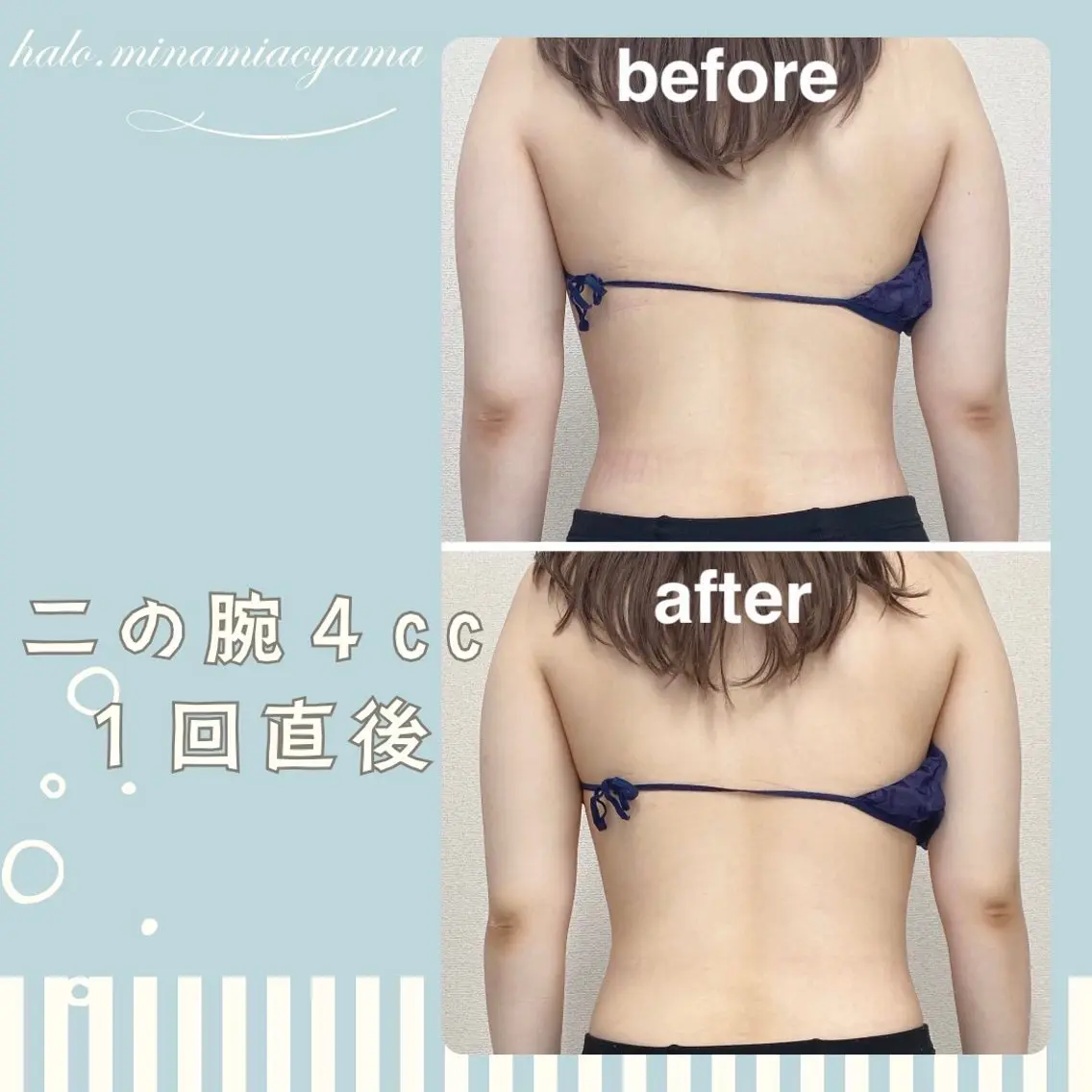 【ミニモ限定】二の腕ハミ肉集中お試し60分の写真