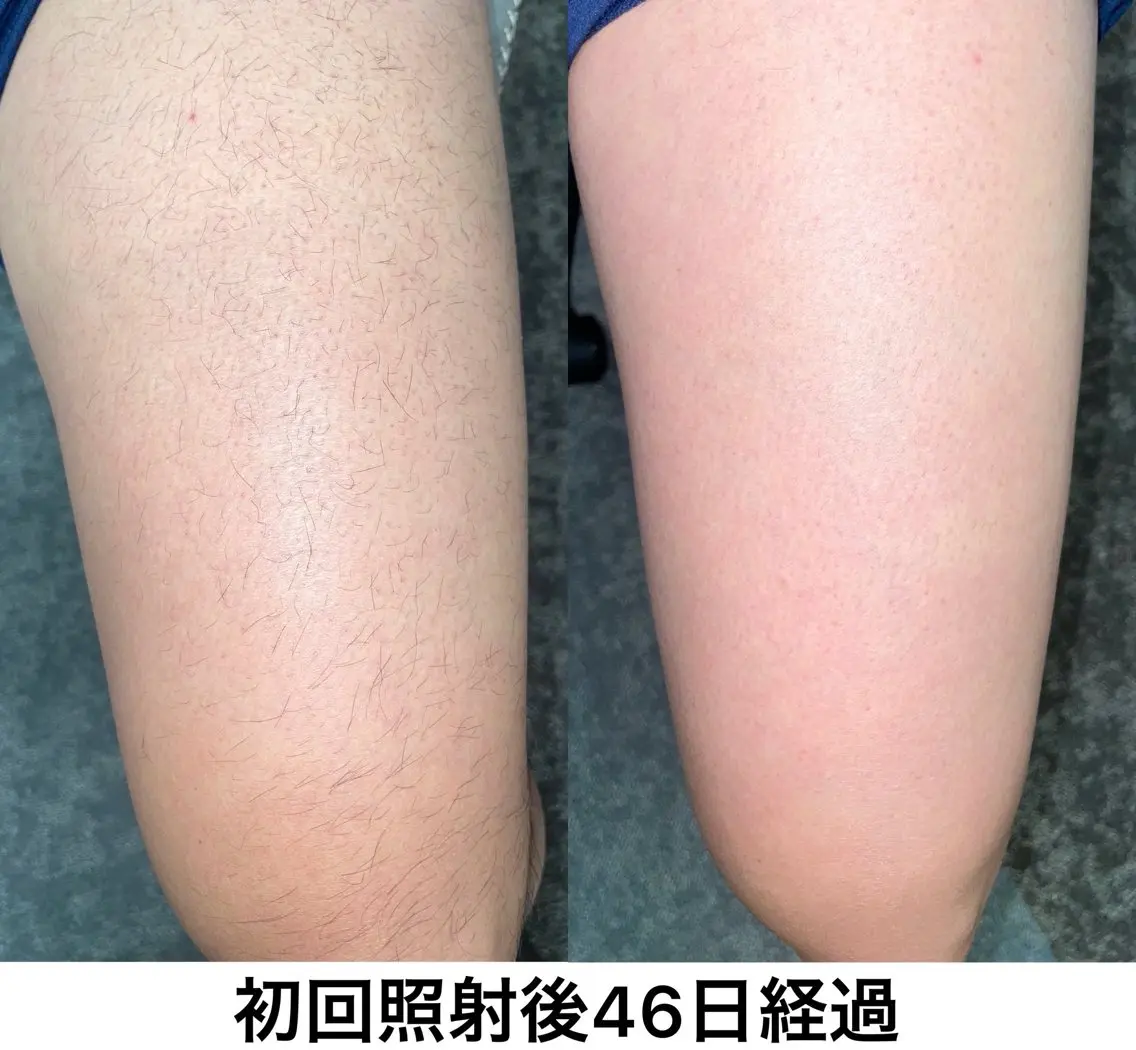 【本格脱毛】 グレイスフルルームのエステ・リラクイメージ