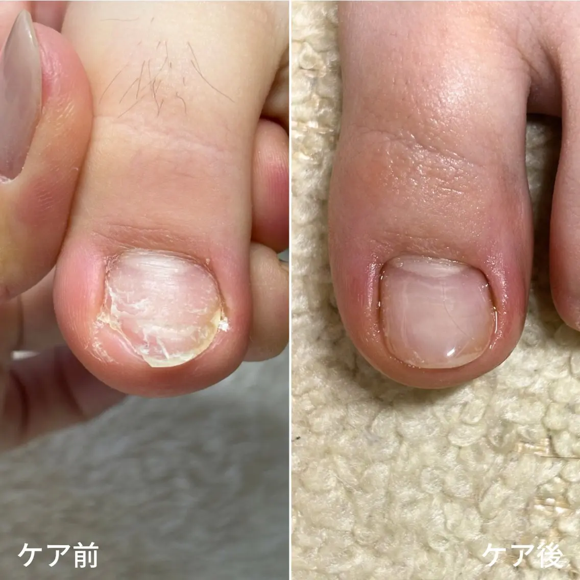 ネイル 巻き爪・肥厚爪ケア 専門サンセリテのネイルデザイン