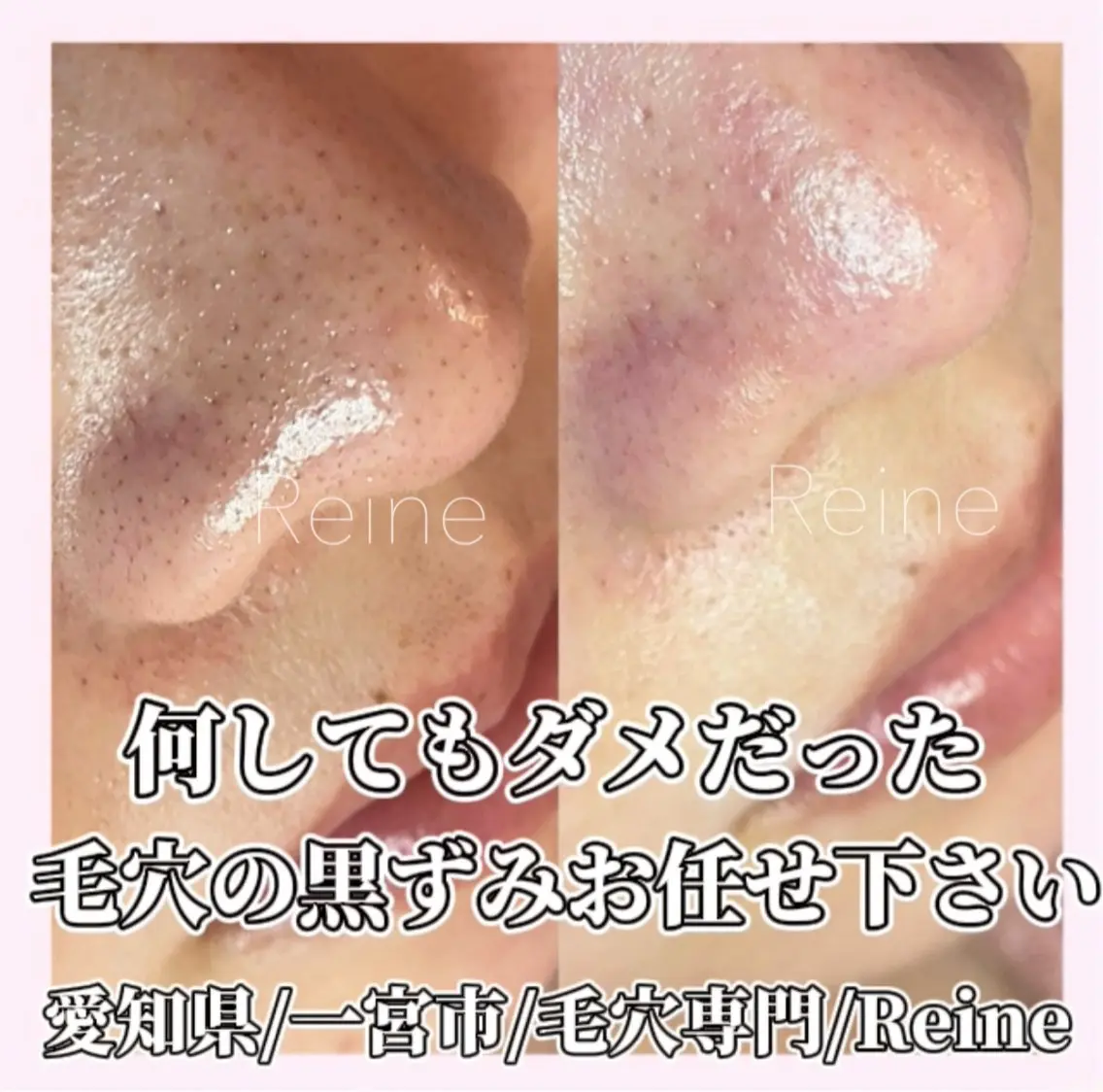 毛穴/シミ肝斑/脱毛 横山梨里のエステ・リラクイメージ
