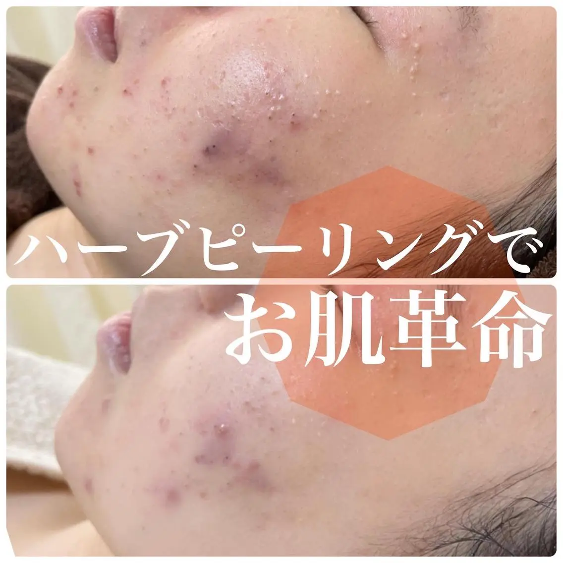 【毛穴・ニキビ】剥けないハーブピーリング(顔)+幹細胞仕上げ付き 定価13,750円の写真