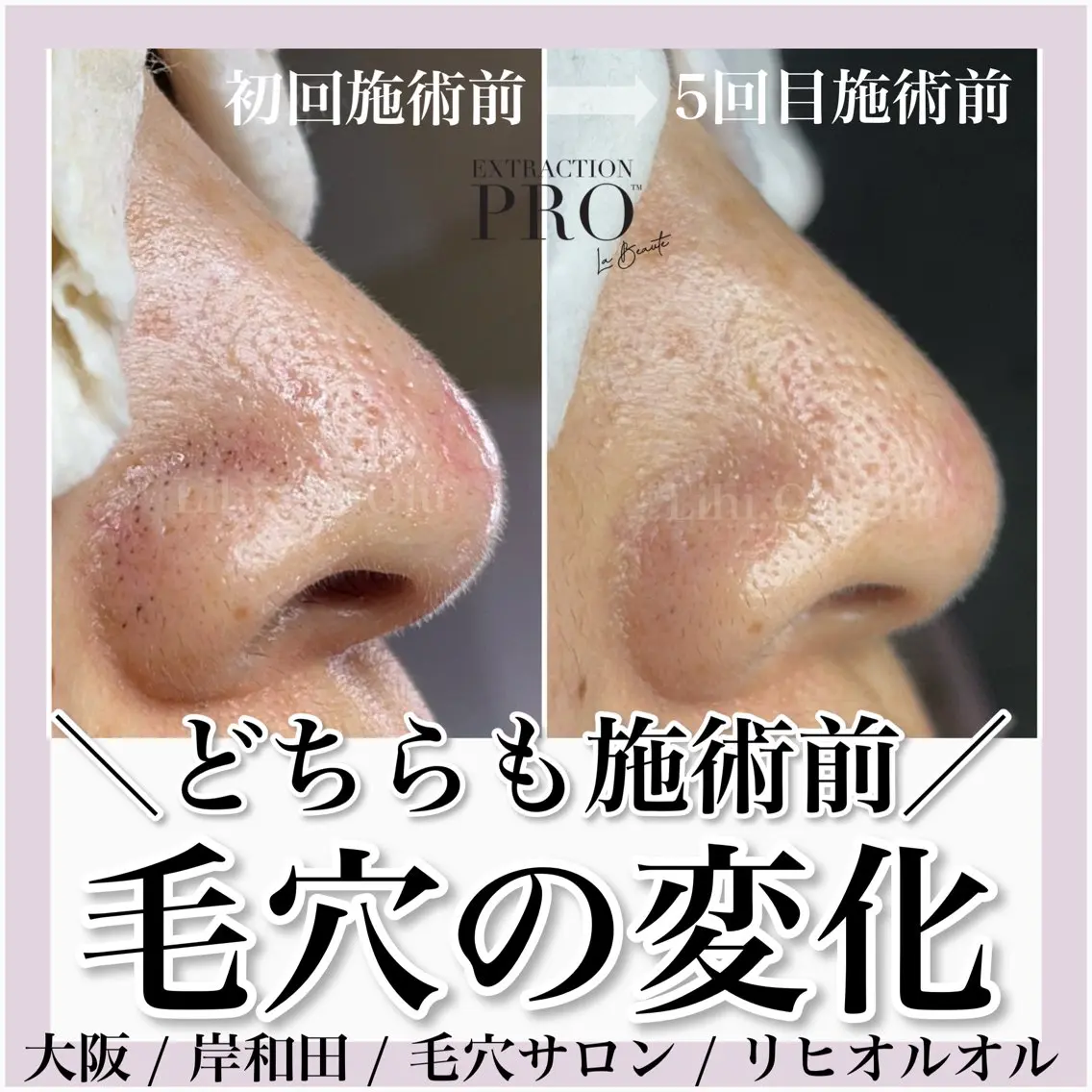 【新規】《美肌デコルテコース》プロの毛穴洗浄でお肌すっきり✨️更に、デコルテ・肩・首・背中まですっきりほぐします🌿‬の写真