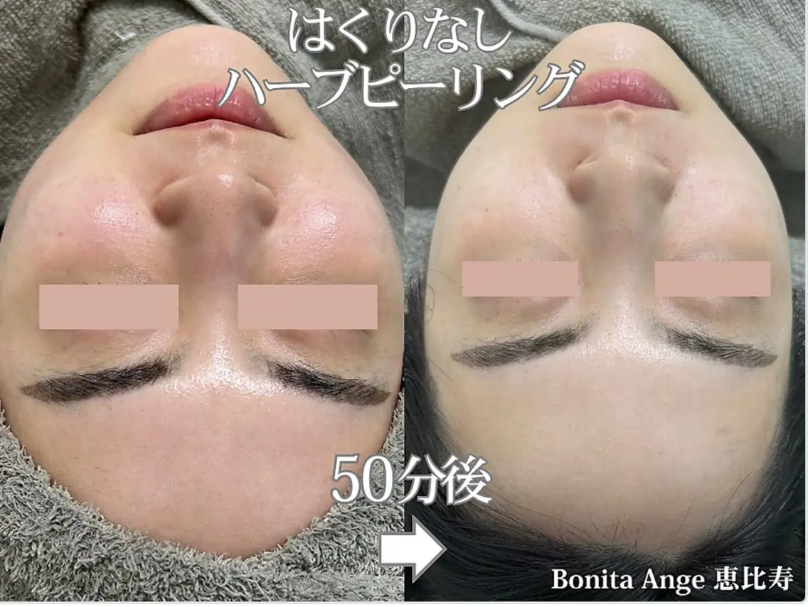 【症例モニター様◆募集】毛穴・ニキビ・肌荒れにお悩みの方『剥離なしハーブピーリング』ダウンタイムなし ¥6660の写真
