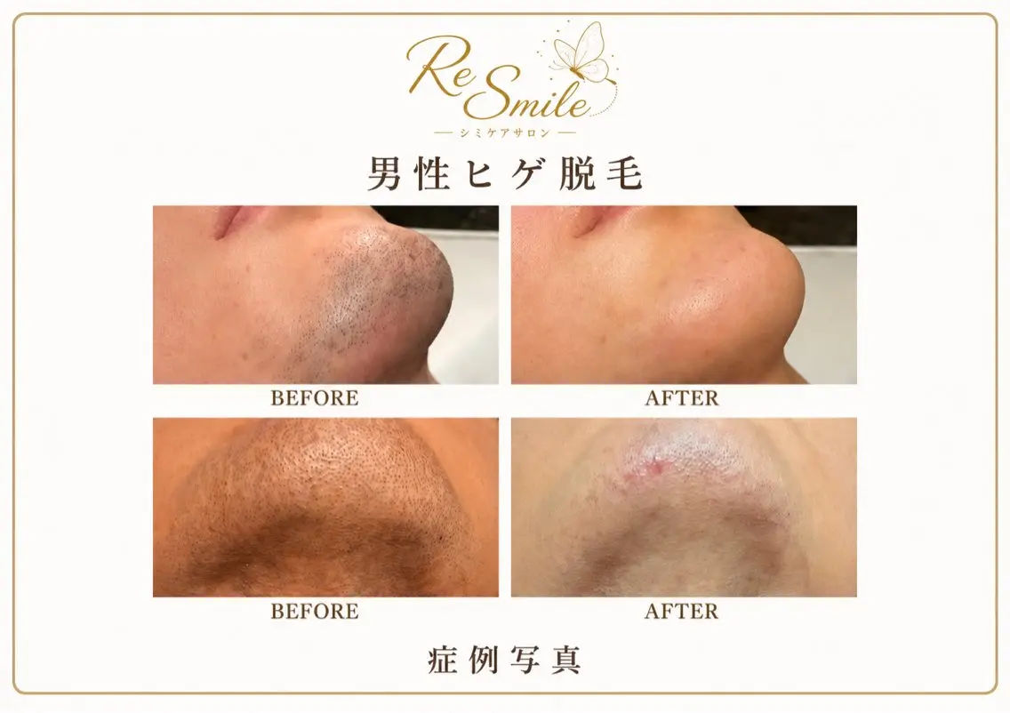 【人気NO.2】ヒゲ脱毛 通常¥9,800⇒3,000の写真