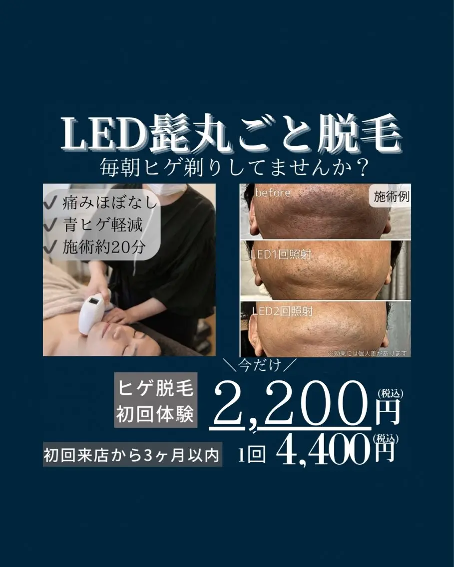 人気No. 2🟦メンズ限定🟦ヒゲ脱毛✨の写真