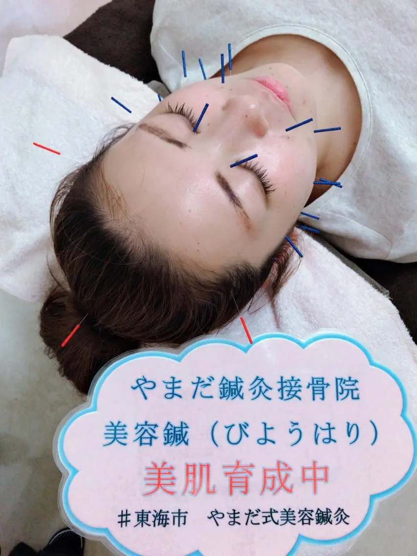美容鍼ベーシックコース（美容鍼コース２回目以降）の写真