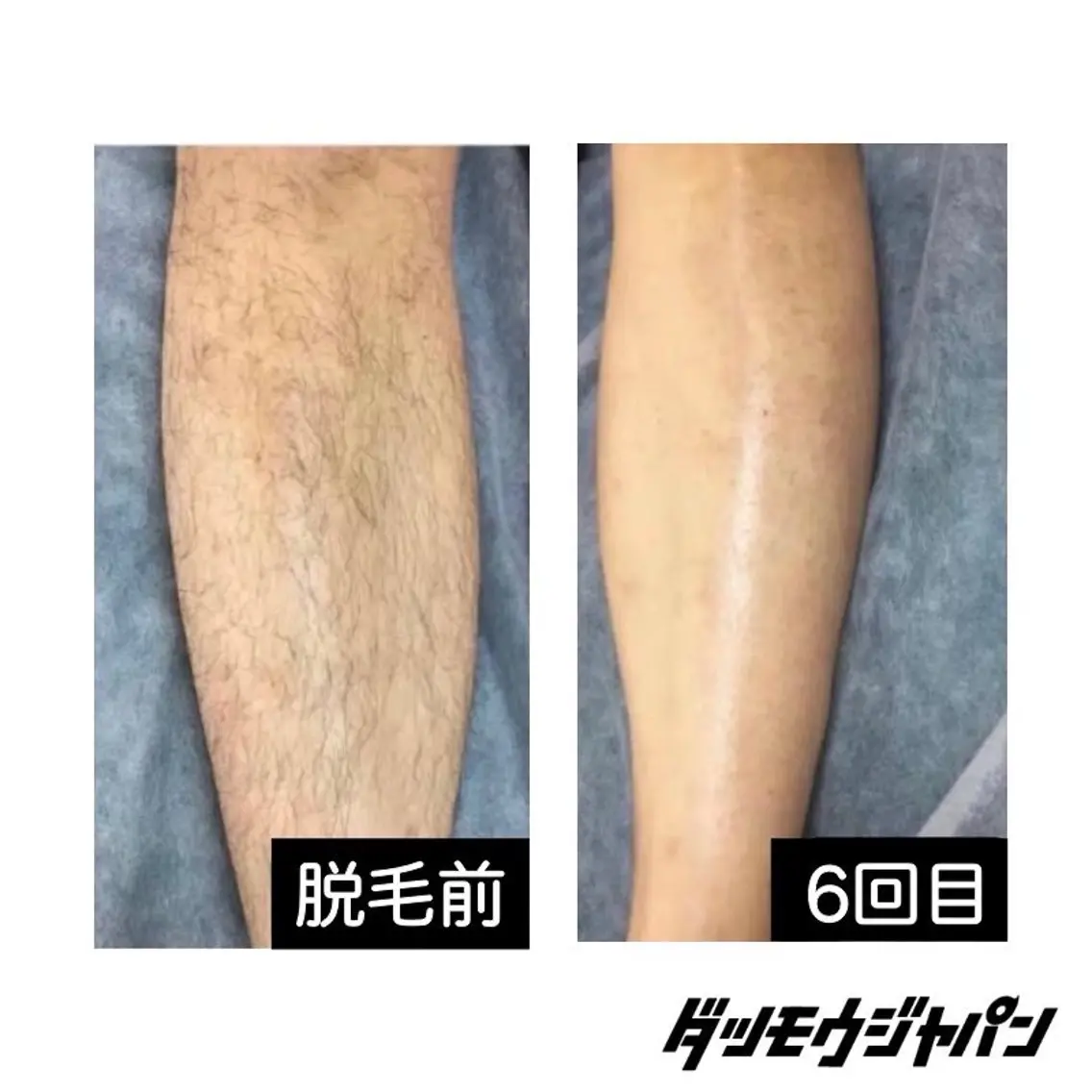 足脱毛(足の甲・指,両ヒザ上・下)の写真