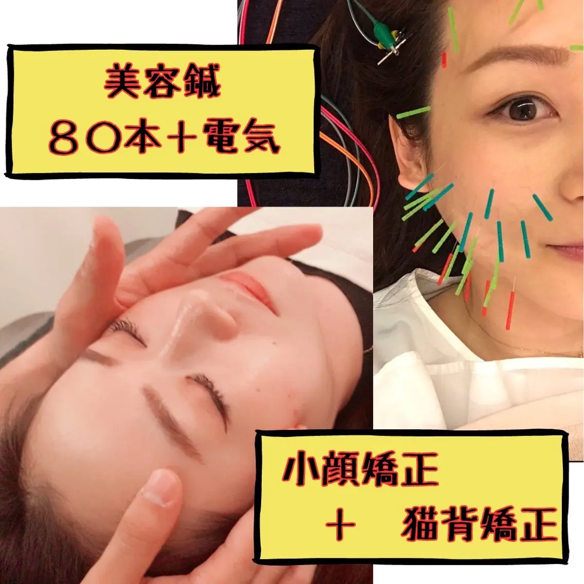 【80本使用】美容鍼＋小顔矯正🌟プレミアムコースの写真