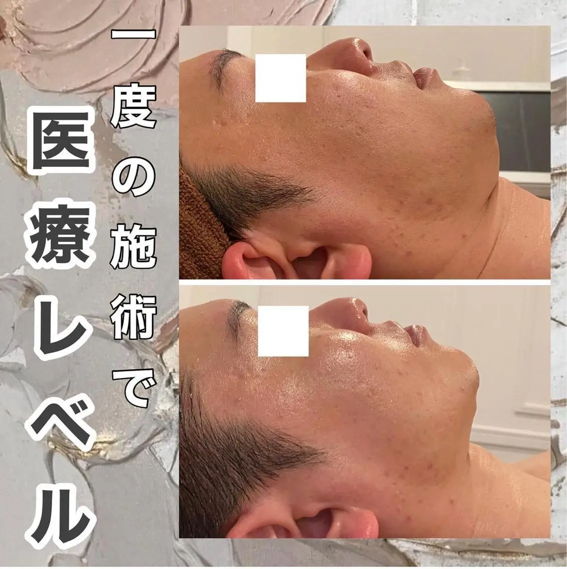 話題のリフトアップ施術💎チタニウムリフト⭐️たっぷり80KJの写真