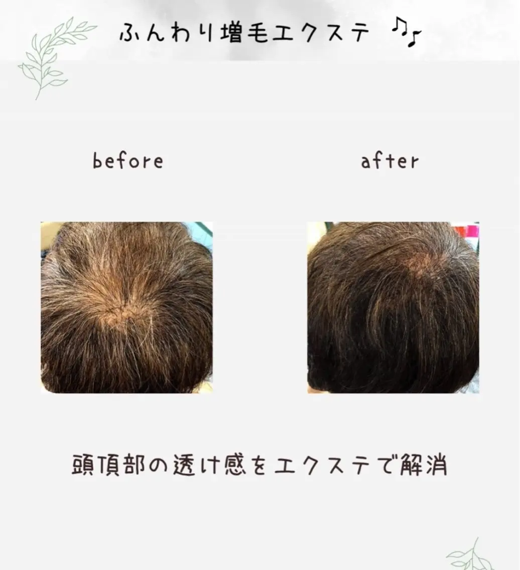 薄毛で悩んでる方向けの増毛エクステ 200〜300本の写真