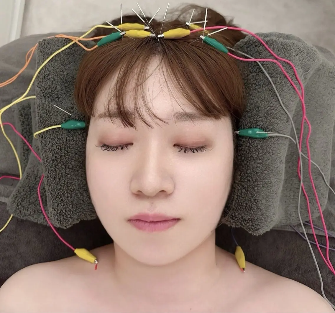 【秋の疲れ・睡眠ケア🌙】寝ても疲れが取れない方に|頭鍼+首肩鍼+ヘッド 40分の写真