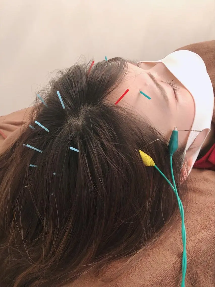 スペシャルヘッドスパ💆🏻♀️❤️🔥ベッド鍼✖︎ヘッドマッサージの写真