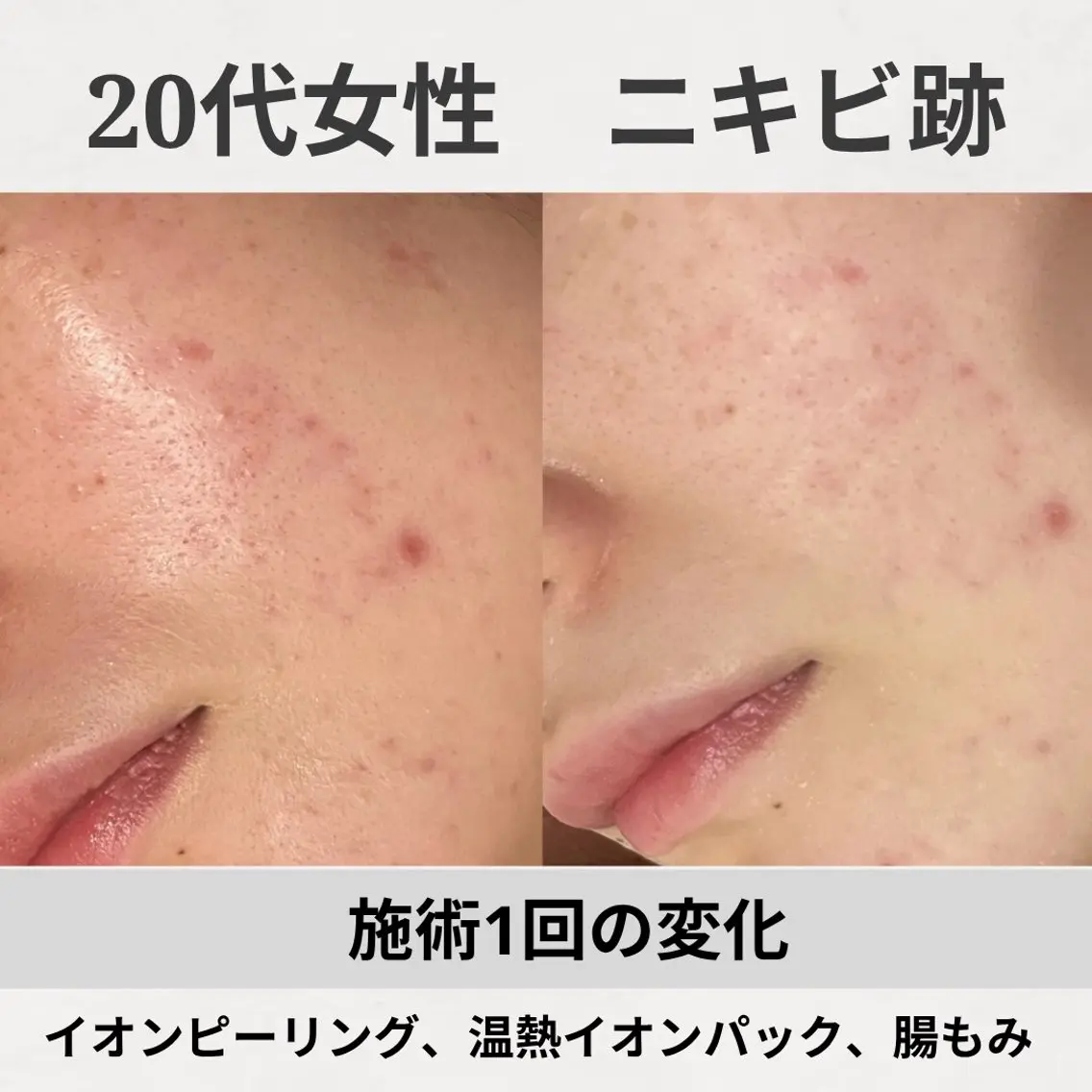 エステ リラク 繰り返すニキビ跡専門 根本改善のエステ・リラクイメージ