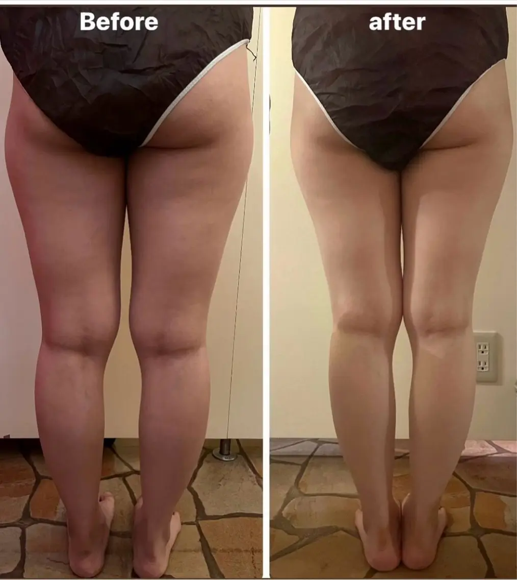 ■ 骨盤深部筋膜ﾘﾘｰｽ➕美脚ｺﾙｷﾞ60分Massage the fat and muscle of the feetの写真