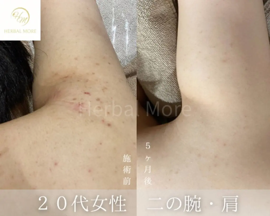 【腕ハーブピーリング/剥離有・無】ニキビケア、色素〇着、毛穴、サメ肌の写真