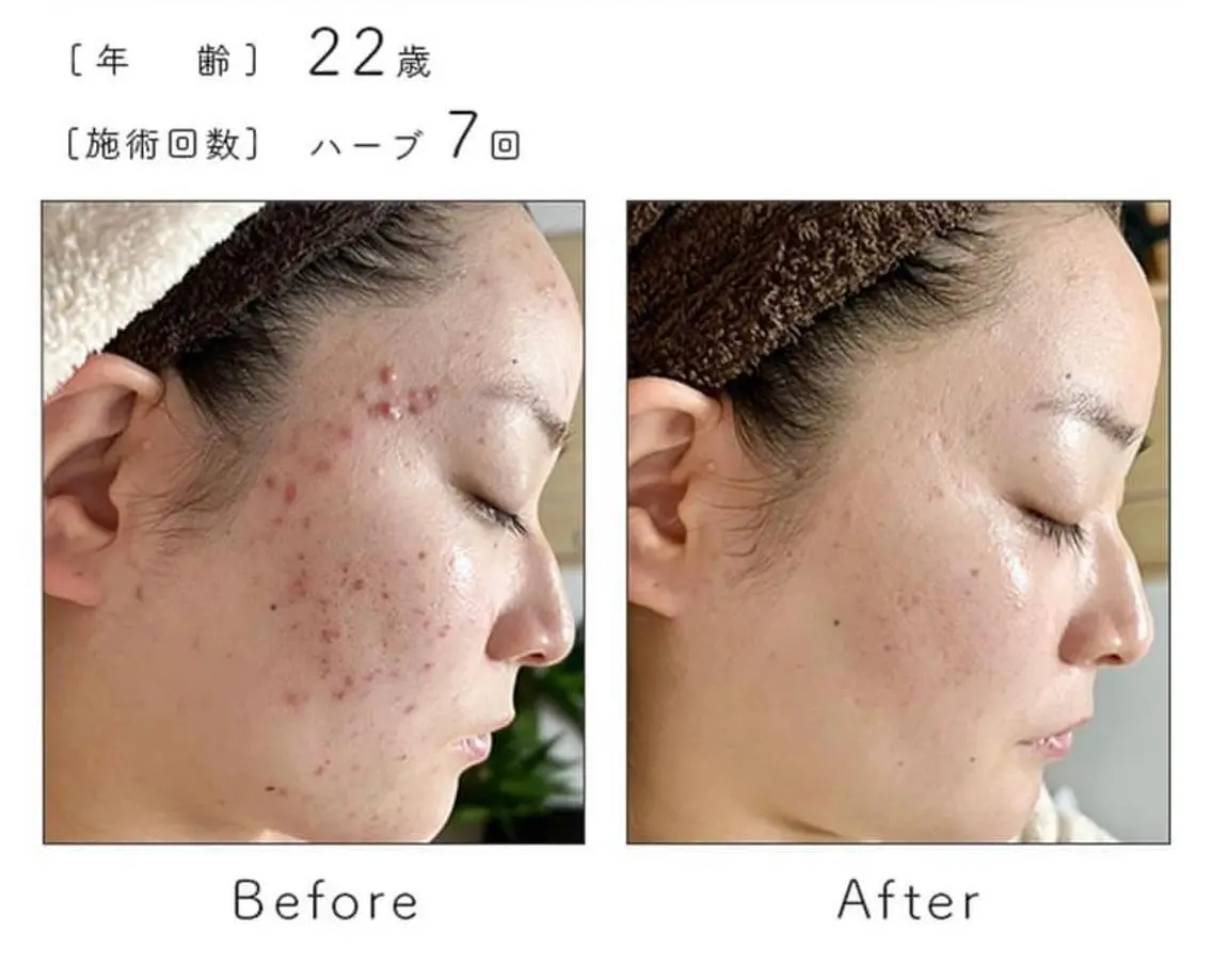 エステ ハーブピーリング専門 BIOPLUS+川崎のエステ・リラクイメージ