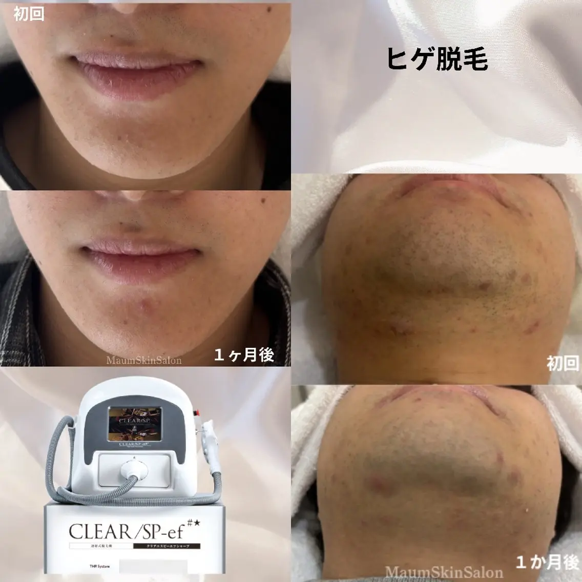 【メンズヒゲ脱毛🧔】SNS掲載OKな方のみモニター価格(美肌ケアなし)の写真