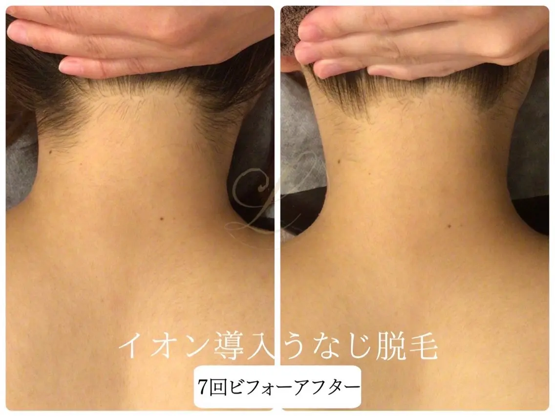 脱毛 🎀うなじ脱毛🎀 ㅣLino堀江のエステ・リラクイメージ