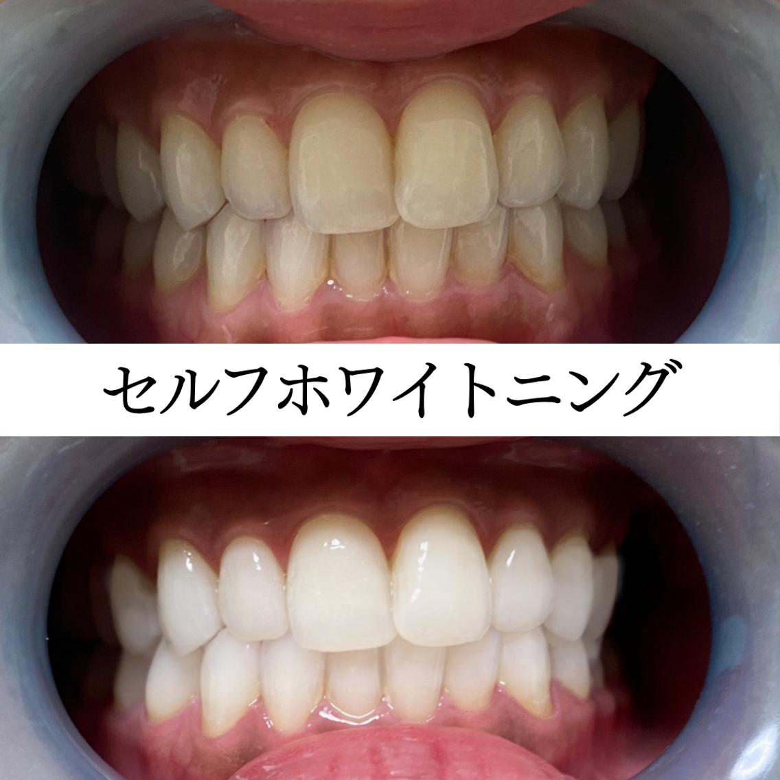 エステ セルフホワイトニング White33久留米のその他イメージ