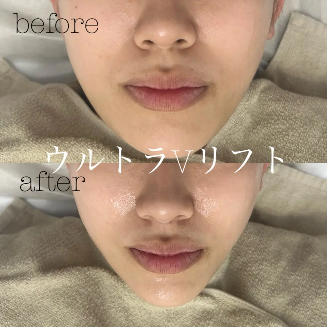 【🩷SNS掲載🆗の方🩷】ウルトラVリフト✨H I F U モデル募集です❤️🔥⭐️速攻小顔効果抜群⭐️の写真