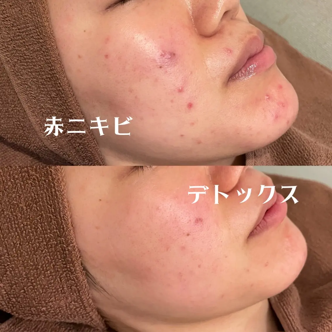 【今だけ！癒し&お肌改善❕✨】お肌改善コース＋Yurumiヘッドマッサージ＋デコルテオイルマッサージ付き🌸の写真