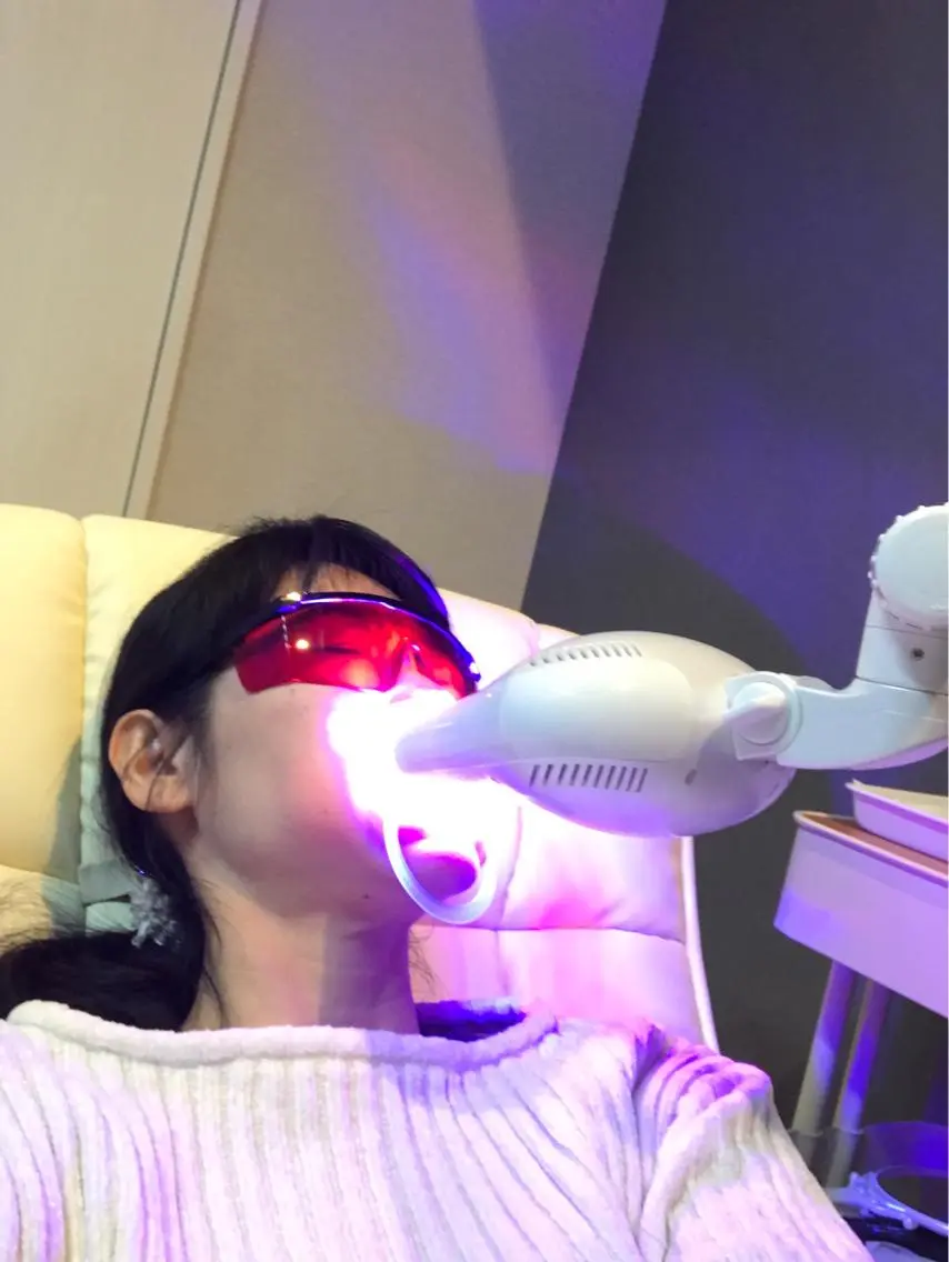 歯のセルフホワイトニング初回の写真