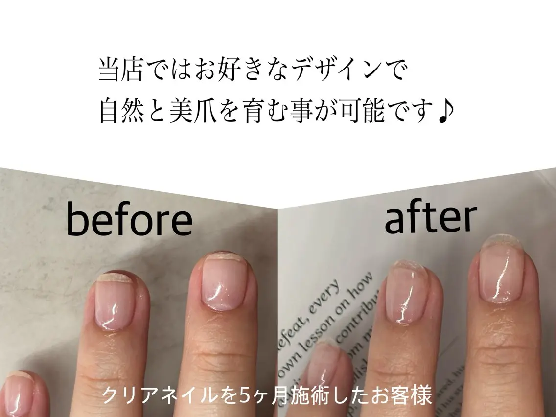 自爪育成　クリアネイルの写真