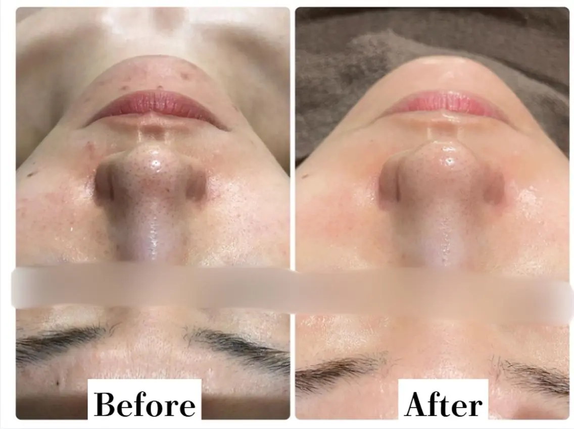 人気No.1肌質改善《リフトアップ美容液導入付》塗る糸リフトハイドロfacial🫧の写真
