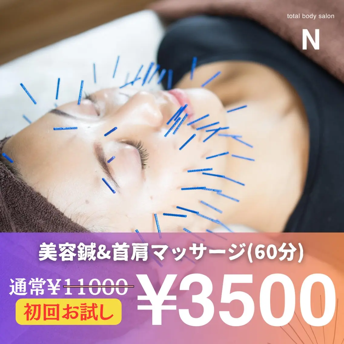 初回限定✨【むくみ・ニキビ・肌荒れ改善!美容鍼80本で小顔&エラ張り解消🔥×エレクトロポレーション50分3,500円】の写真
