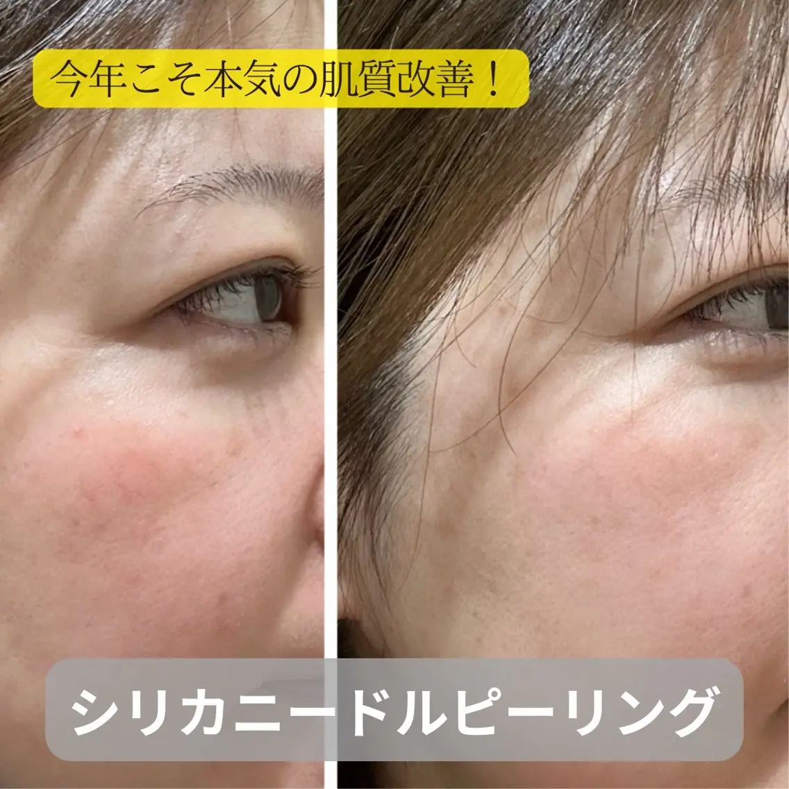 【ミニモ限定】ニキビ肌改善シリカニードルピーリング!剥離なし花粉症の方⭕️ミニ美容液🎁付 ニキビ肌/毛穴レス/赤みの写真