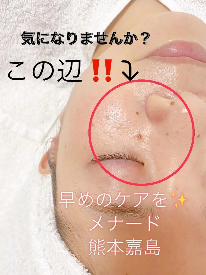 🌹ザラつき✧ゴワゴワ肌🌹アドバンス+ハーブピーリングパックでツルツルすべすべ肌に🥰¥9900→初回¥4400✨の写真