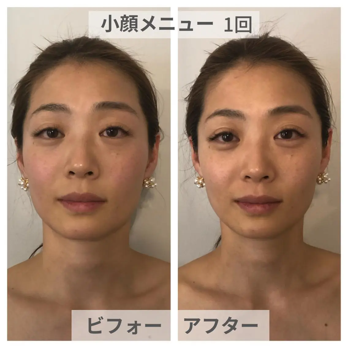 【小顔3Dリフト】50分💎ラジオ波で温め＆ハンドでほぐす！即効むくみオフ×立体フェイス✨の写真