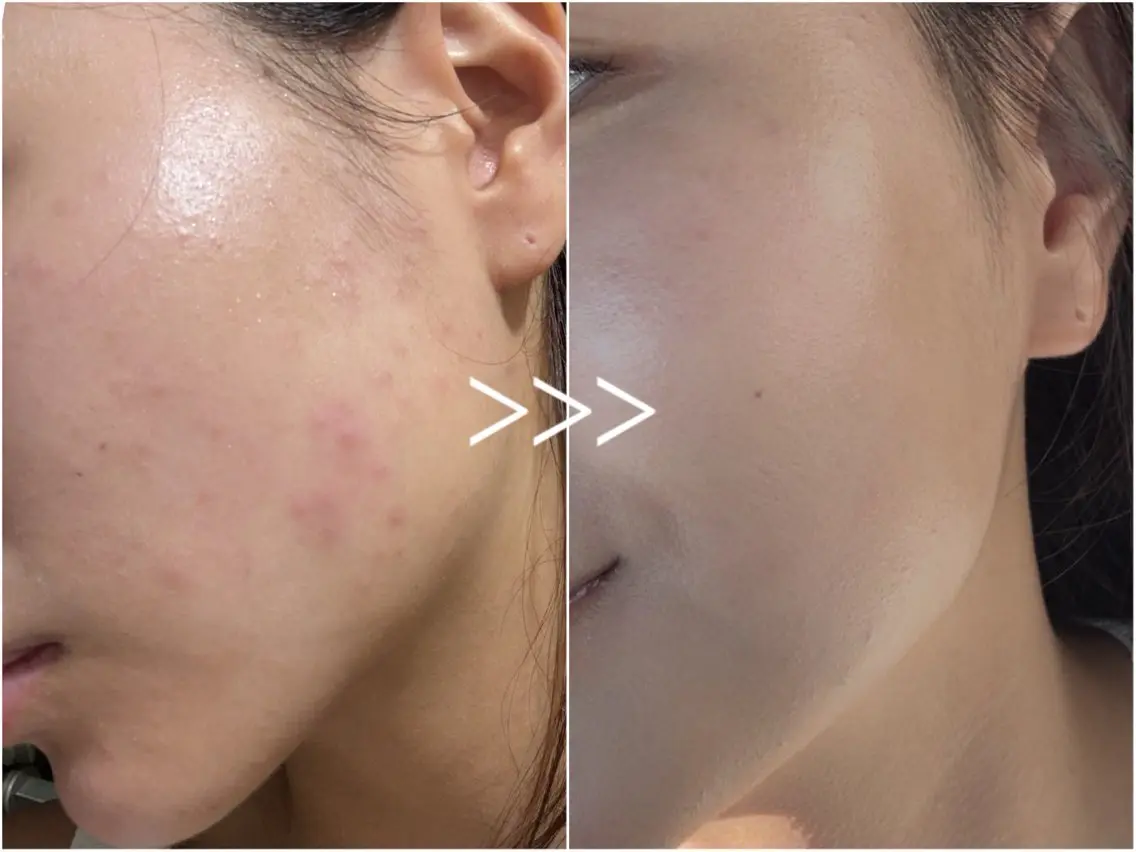 毛穴開き黒ずみ ニキビ特化💆♀️のエステ・リラクイメージ
