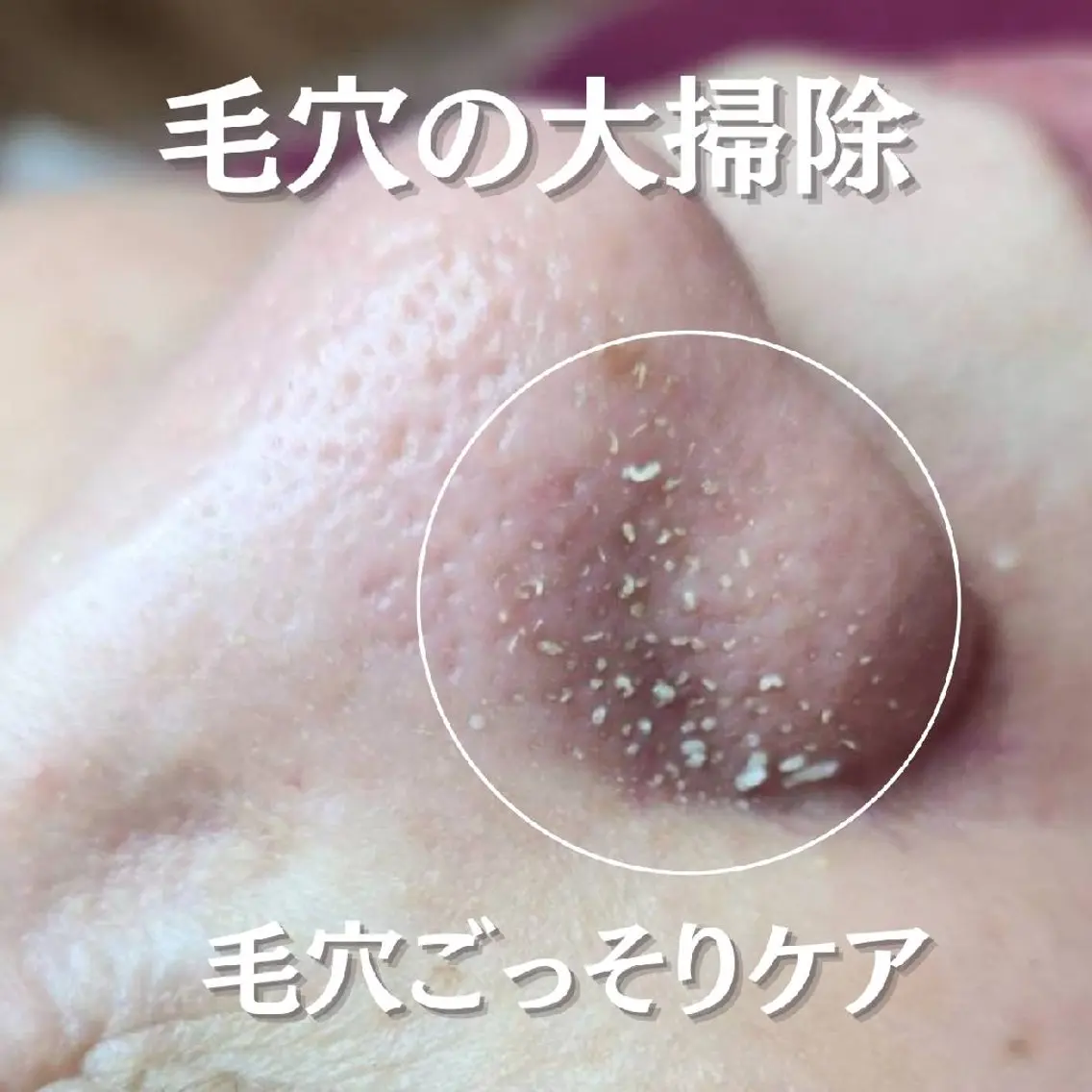 リニューアル記念✨黒ずみ除去!毛穴洗浄&酵素パック♡の写真