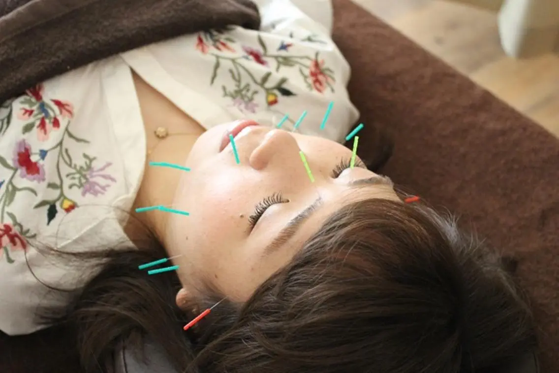 むくみスッキリ小顔に　【美容はり】の写真