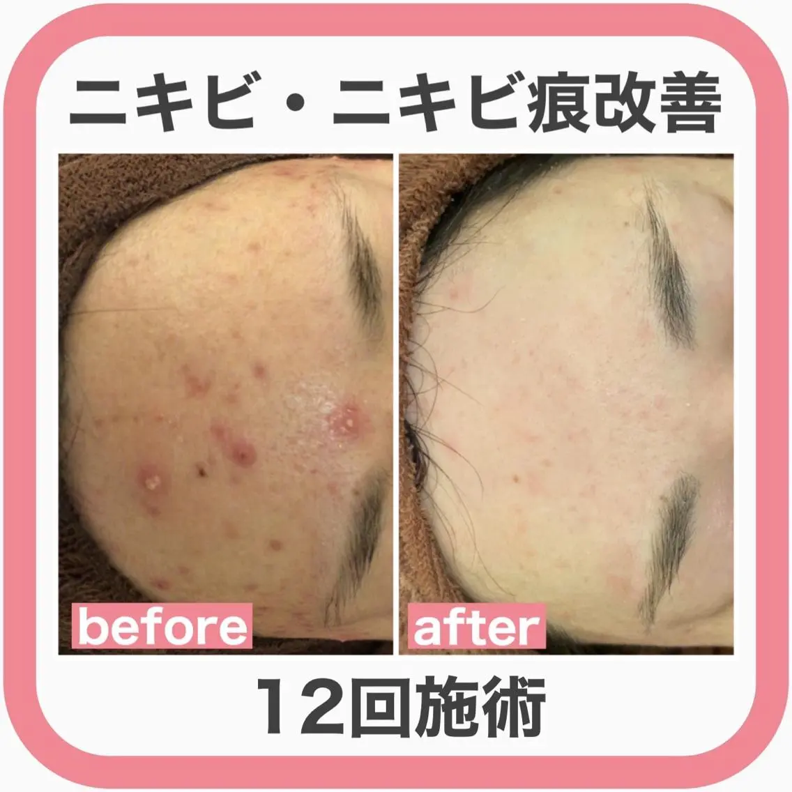 セミロング カラー パーマ ヘアアレンジ メンズ キッズ ネイル マツエク・マツパ アイブロウ 3か月で肌革命👼 ニキビ専門店💫のエステ・リラクイメージ