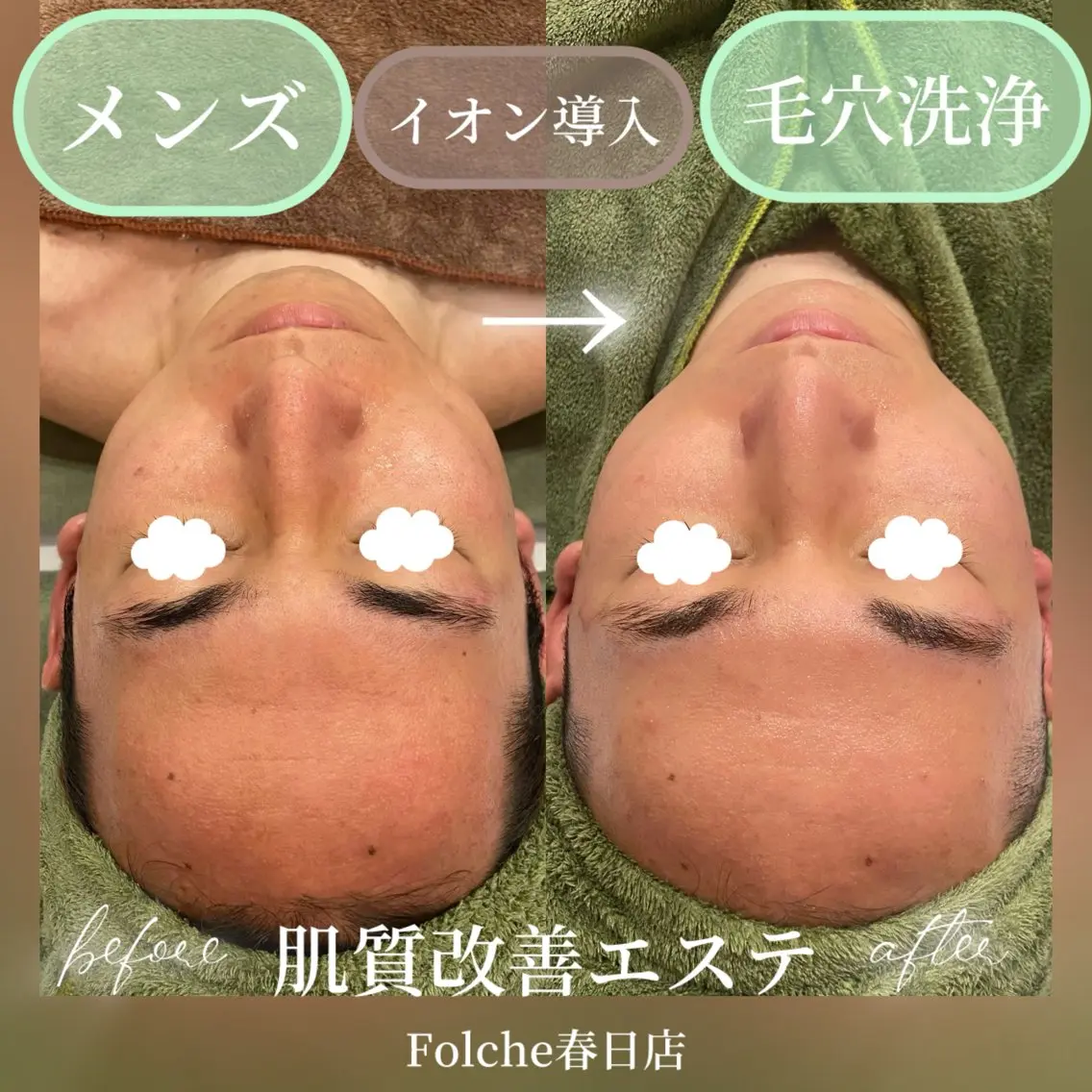 【メンズクーポン】肌質改善フェイシャル/毛穴洗浄+ポレーション+イオン導入 フェイシャル✨の写真