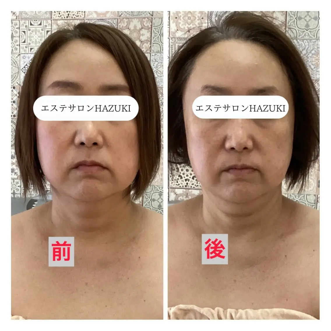その他 たるみ改善小顔エステ 堀葉月のその他イメージ