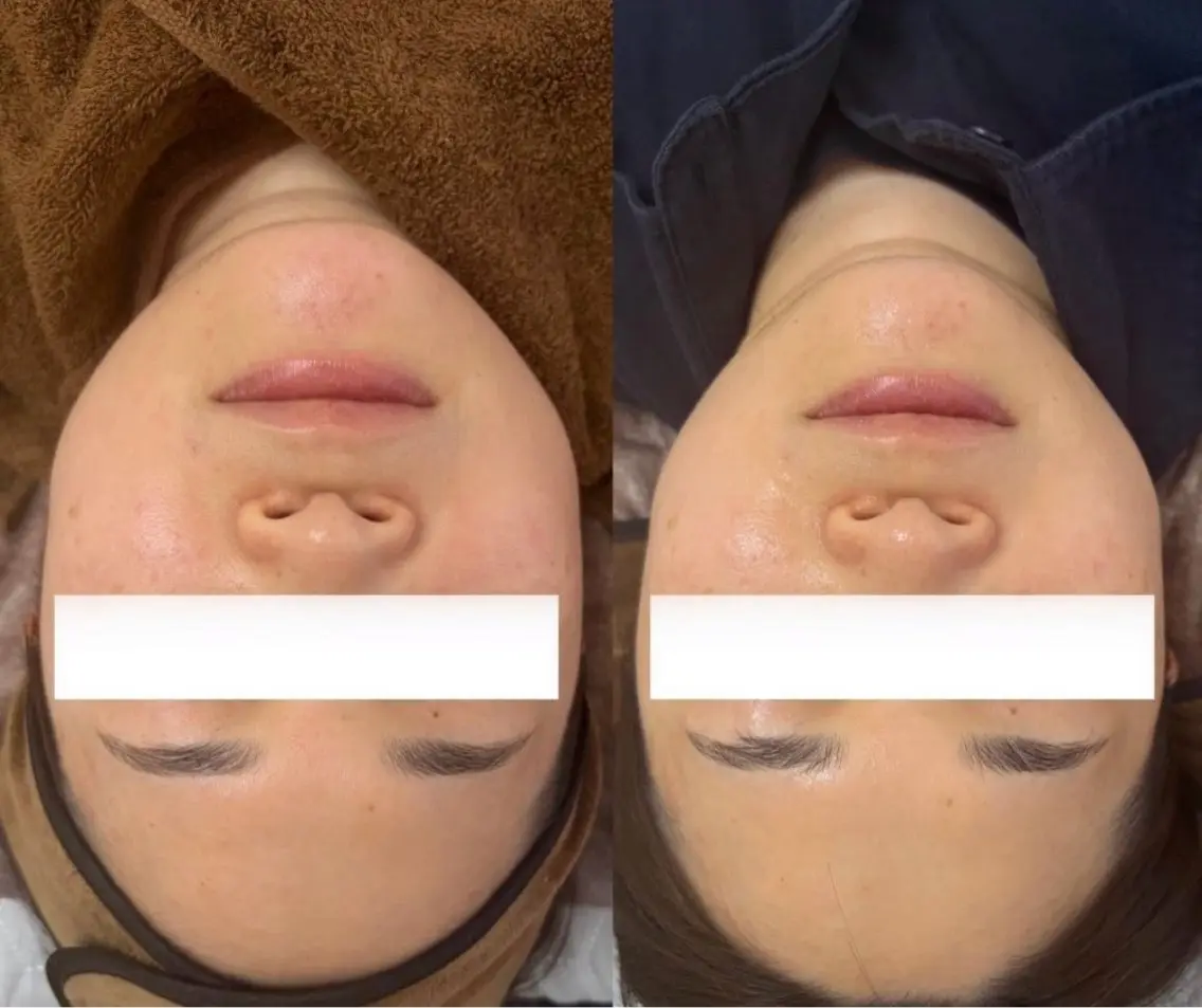 エステ 毛穴レス美肌へ🌿 看護師Abe🌼のエステ・リラクイメージ