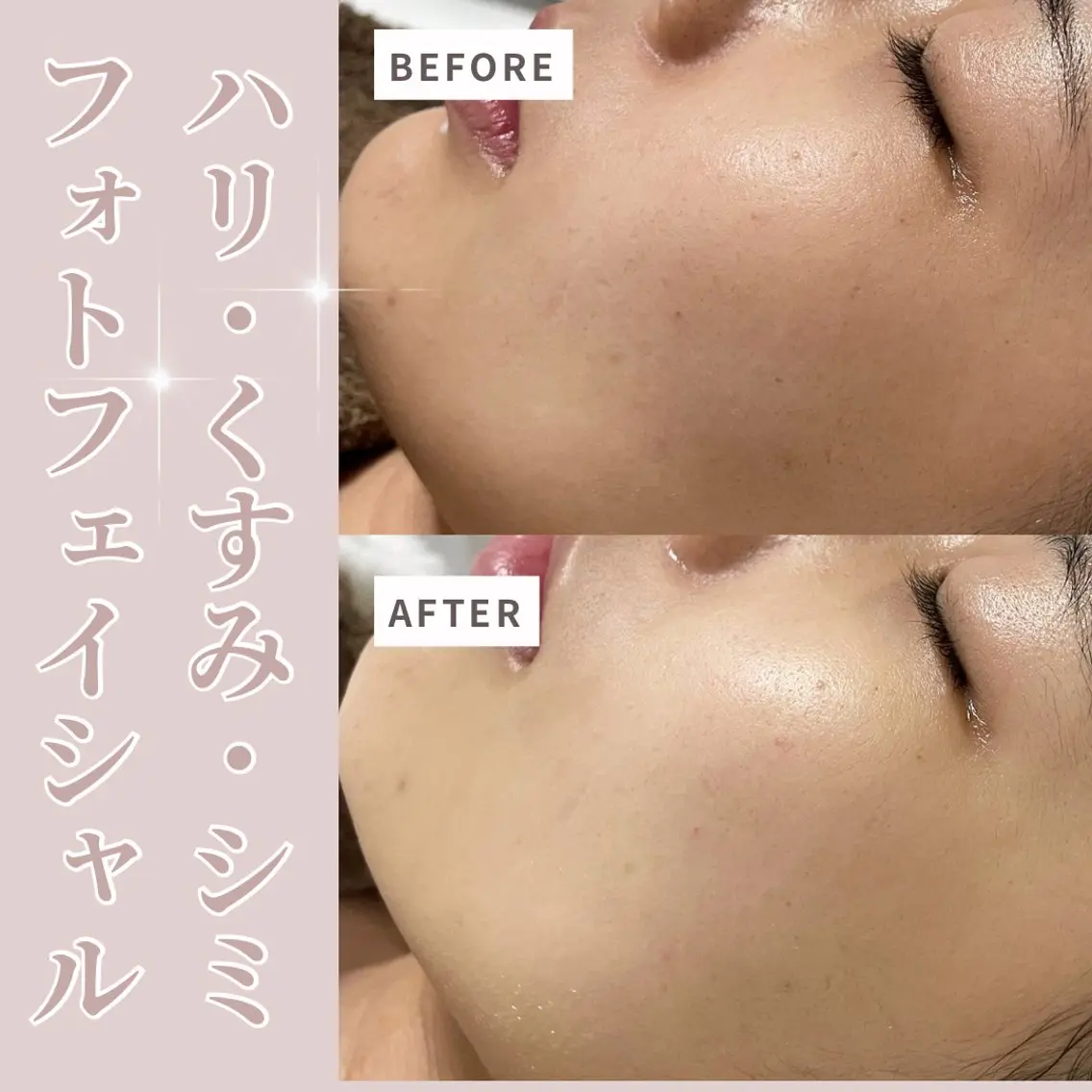 【内側のケア❣️】光フェイシャル💡✨パック付きの写真