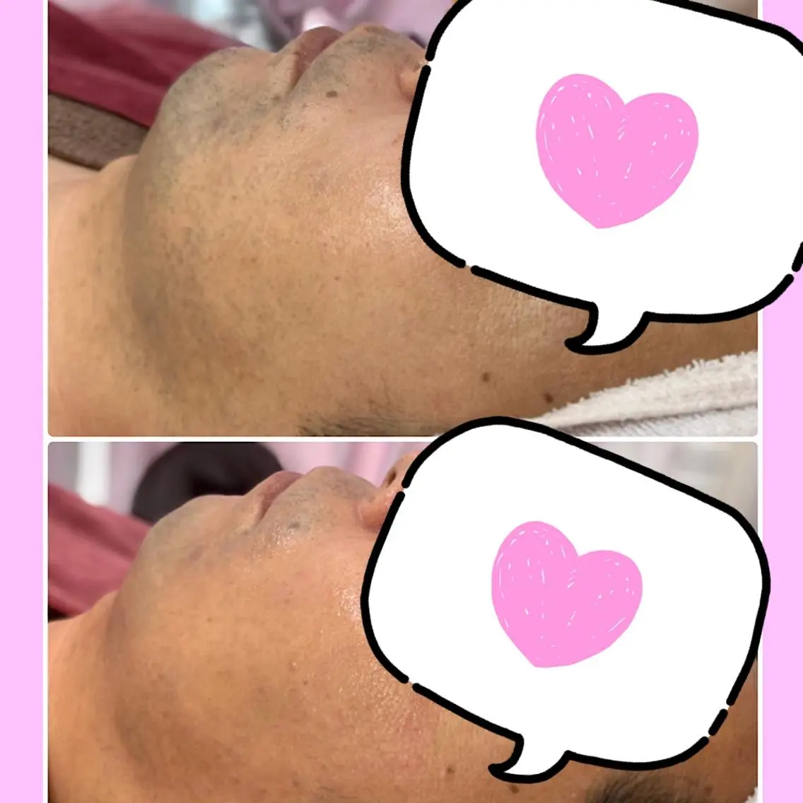【メンズ脱毛】ひげ脱毛 2週間ごとにできる脱毛 ひげの箇所のみの脱毛です ひげをそってきてくださいの写真