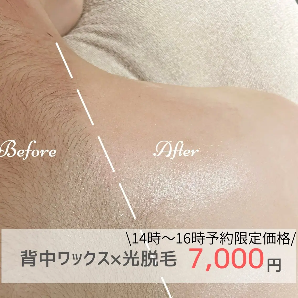 女性/【14時​〜​16時予約限定】背中ワックス脱毛×光脱毛14時​〜​16時予約限定¥9,000→¥7,000の写真