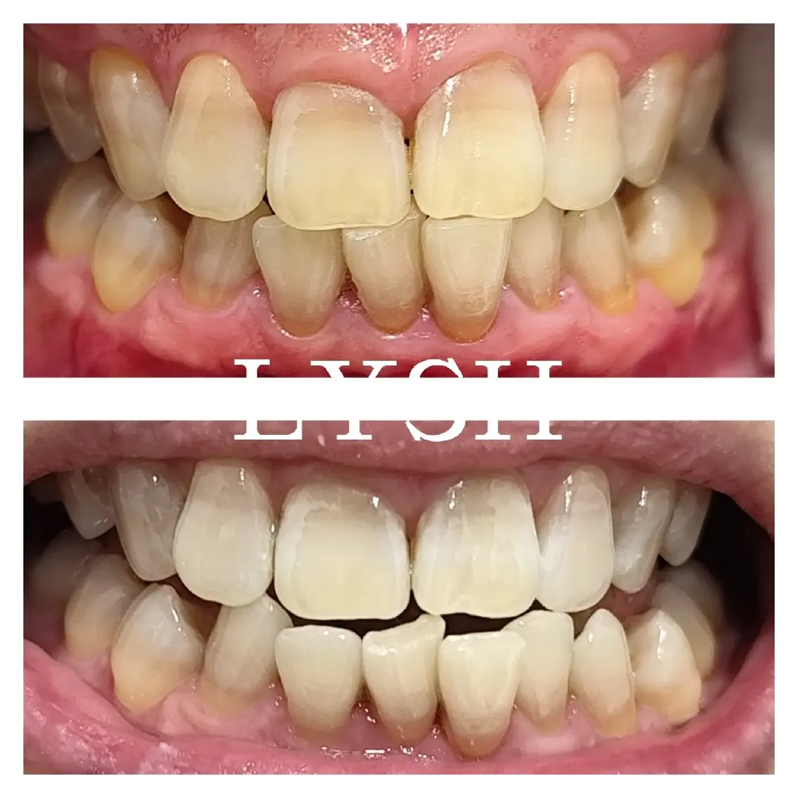 45分で歯の色にトーンアップ🦷セルフホワイトニングの写真